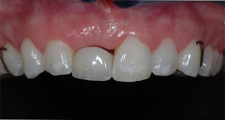 Transitional restorations at implant sites 